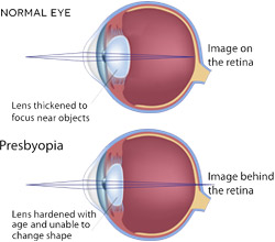 Presbyopia Diagram